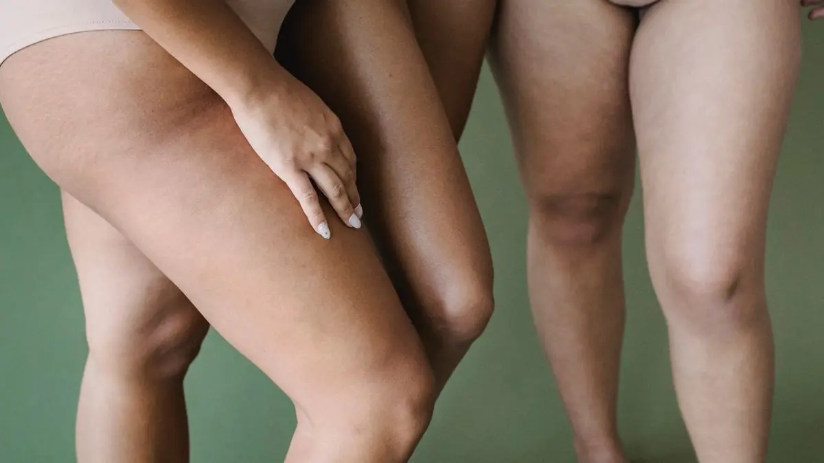 Cellulite sur les cuisses : 3 méthodes qui marchent