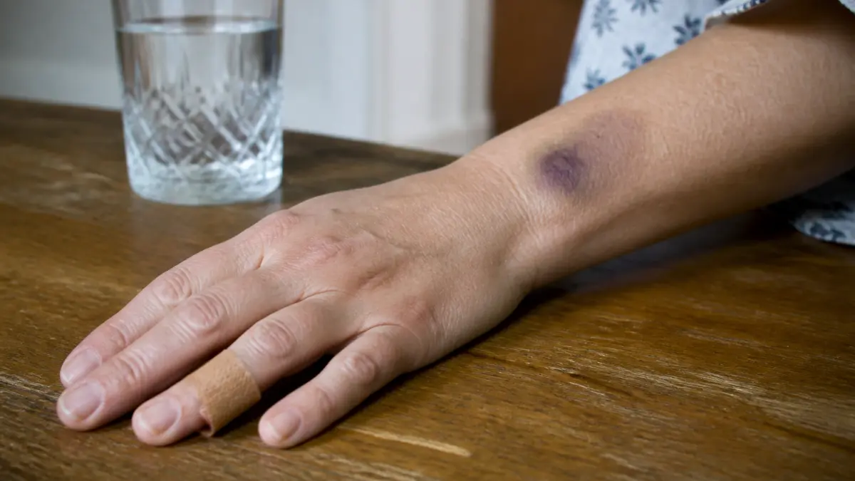 Plaquettes basses : 5 symptômes à ne pas ignorer